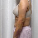 지방 | 팔지방흡입후기 결혼다이어트 4달차 변화비교