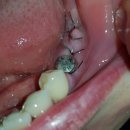 김준형치과의원 | [마포점] 바른약속치과 오스템 임플란트 수술 후기 (혐오주의)