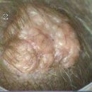 Sebaceous Adenoma(피지선종) 이미지