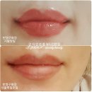 강자안손톱 이미지