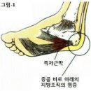 ※※발다닥통증 (그 원인은 무엇인가?) 이미지