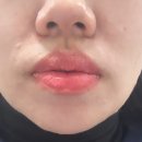 씨네시티한일빌딩 | 대구 동성로 지방분해주사 / 대구 심부볼 관리 / 상상하던 얼굴라인 윤곽주사 지방분해
