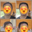 테라피네일 | 안양네일샵 미엘네일 두피 플라즈마 테라피 받아본 후기