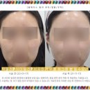 단아한미인의원 | 세종시턱필러? 이마필러? 성공하기 위해 체크해 볼 필수요건