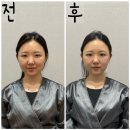 [양산성형외과] 슈링크 300샷 효과 솔직 후기