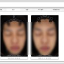 차고치는남자 | [간증글] 30대 남자 엘라비에 리투오(스킨부스터) 3cc 및 아토스레이저 후기 / 통증, 전후, 주기, 가격