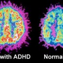 ADHD 자가진단 원인 증상 치료 유아 초등 ADHD 성인 ADHD 이미지