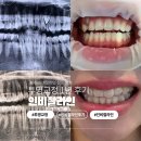 남문튼튼치과의원 | 인비절라인 1년 차 관리 후기 제주고운이치과교정과