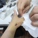 의료법인 고운손 의료재단 | 엄지손가락 골절 핀 수술 입원 재활 후기