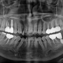 엔도코어 이미지