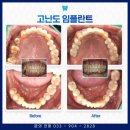 태장고려의원 | 원주 어금니 임플란트 신중하게 선택해요