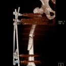 다리골절[발목,복숭아뼈. 슬개골탈구]수술치료후 후유장해보험금[장애진단서] 청구 이미지