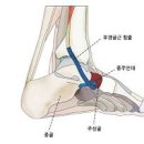 발바닥 아치 통증 부주상골증후군 증상 원인 이미지