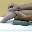 (치료)subtalar joint traction mobilization 이미지