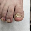 포쉬네일 오벨리네일푸스 금천점 | 금천 무좀 파고드는발톱 재방문 솔직후기 오벨리네일푸스 족보있는그녀들 금천점