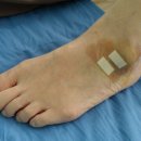 족부 염좌 - 발목, 발 통증과 비골근 (peroneal muscle) 이미지