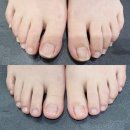 메디셀 | [건강] 발톱무좀약, 메디셀온 고농축 발톱앰플