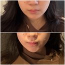 삼성바른병원 | 삼성역피부과 티베룩 티타늄리프팅 쥬베룩볼륨 내돈내산 후기