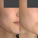 클리니크후즈후의원 | 클리니크 후즈후가 특허받은 치료 자가엑소좀(mysome) 효과, 후기 설명