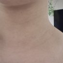 하늘체한의원 | 좁쌀 여드름인 줄 알았던 얼굴·목 편평사마귀 무제한 제거 리얼 후기 (압구정 하늘체한의원/통증/딱지)