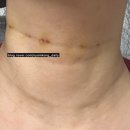 공주사 | 청담공의원(공클리닉), 디어넥주사 선천적 목주름주사 내돈내산 리얼후기 2회차