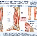 정강이 안쪽이 아프다면? Shin Splints·내측경골스트레스증후군과 마사지 이미지