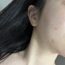 생피부관리실 | [압구정 피부과] 여드름 손으로 짠 흉터 시너지포커스테라피로 3일만에 없앤 극사실후기