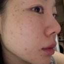 다음 | 얼굴 전체 편평사마귀 제거 후기 (당일~다음날, 듀오덤 꼭 필요할까)