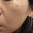 봉암약국 | [1년후 최근사진 첨부] 내돈내산!!봉암동 봉암 중앙의원 점. 기미제거(2개월 후 .1년 후 현재 사진첨부)