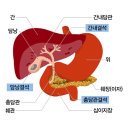 ■ 담낭 결석(GB Stone)의 원인. 증상. 치료 이미지
