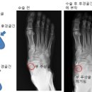 부주상골 증후군 (발등 통증 원인, 성장통) 이미지