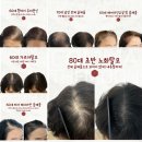 에이콤마 뷰티 | “두피문신,몇살까지 가능할까요?” 77세 고객님 실제 이야기