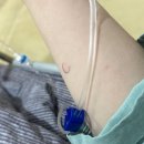 갑지 | 이하선종양 수술후기 (1)