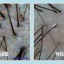 신생모 | [닥터모락 연신내점]💆‍♀️열감·피지 개선 & 신생모 케어 후기