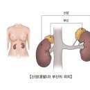 급성 신부전(Acute renal failure) 이미지