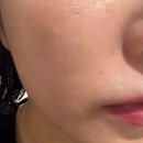 하얀멍이 | 부산 서면 리투오 시술 후기ㅣ1주일 10일 후 피부 변화 솔직하게(내돈내산)