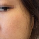 초이스뷰티 | 김포 모공 여드름흉터 관리후기초이스뷰티 플라즈마 (써마지) 비포애프터