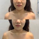 청주 윤곽관리 &lt;후광미인&gt; 작은얼굴관리 후기/1회만으로 효과 굿(비포&amp;애프터 사진有)