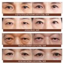 반듯한 멍이 | 나이 들어 보이는 눈가 때문에 눈매 교정수술한 엄마의 동안성형 기록(1)