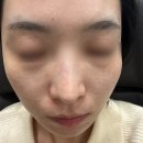 생명한의원 | 강남역여드름한의원 여드름흉터시술 새살침 2회차 내돈내산 후기