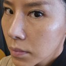 성수역피부과 온다리프팅 솔직후기