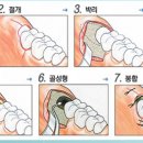 첫사랑니치과의원 네이버블로그