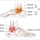 염좌의 초기 치료 이미지