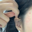 이수역 5번 출구 앞 | 편평사마귀제거 레이저 제거 후기, 이수역 뷰티스톤의원 추천!✨