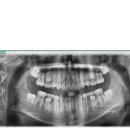 아이퍼스트치과병원 | 초등 인비절라인 퍼스트 8개월 후기ㅣ부정교합 앵글 2급 보험 200만원 수령
