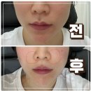 바노바기의원 창원 세르프 후기 통증 멍 주의사항 가격