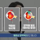 눈앞에 뭔가 떠다니는 느낌? 비문증 증상 원인 치료 이미지