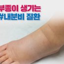 발이 붓는 이유는 무엇이 있을까 이미지