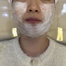 올페이스짐 | 홍대입구 이중턱살 심부볼처짐 즉각 효과 좋은 튠페이스 티타늄리프팅 후기