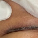 라인2차 | 아이라인 반영구 제거 2차후기